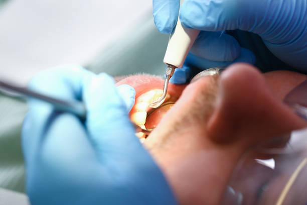 Best Dental Abscess Treatment in Marin City, CA