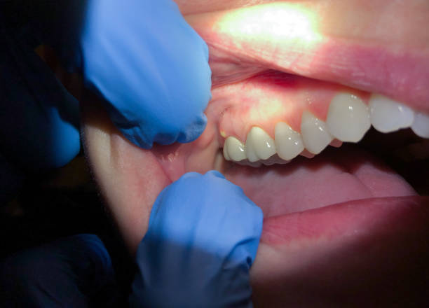 Best Emergency Care for Gum Disease in Marin City, CA